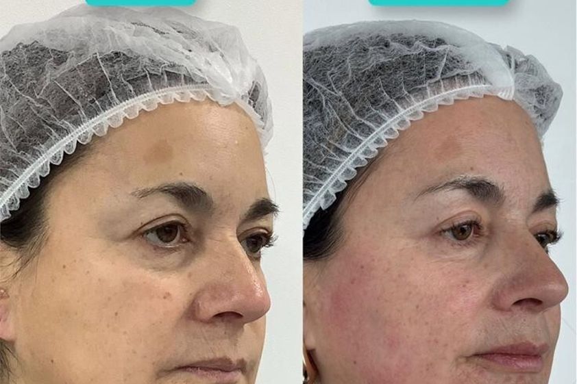 Armonización facial antes y después - 878187