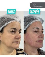 Armonización Facial - Clinica Visage
