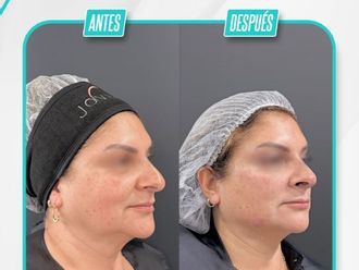 Armonización facial antes y después - 879162