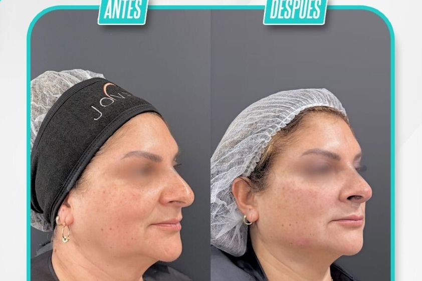 Armonización facial antes y después - 879162
