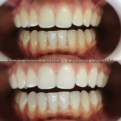 Blanqueamiento dental - Dra. María Belén Castillo