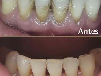 Limpieza dental - 843769