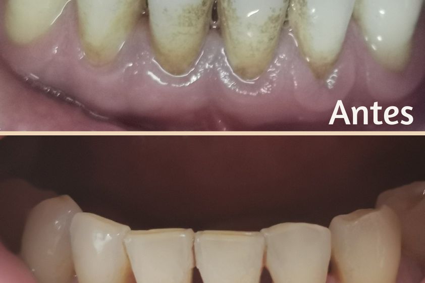 Limpieza dental antes y después - 843769