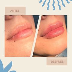 Aumento de labios - Dra. María Belén Castillo