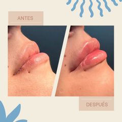 Aumento de labios - Dra. María Belén Castillo