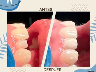 Carillas dentales antes y después - 869778