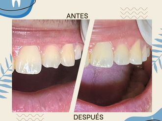 Carillas dentales antes y después - 869779