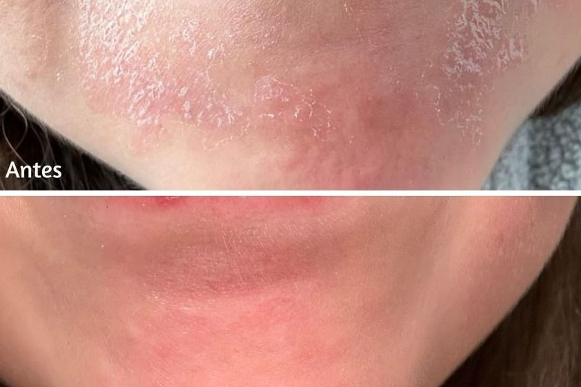 Mesoterapia antes y después - 869783