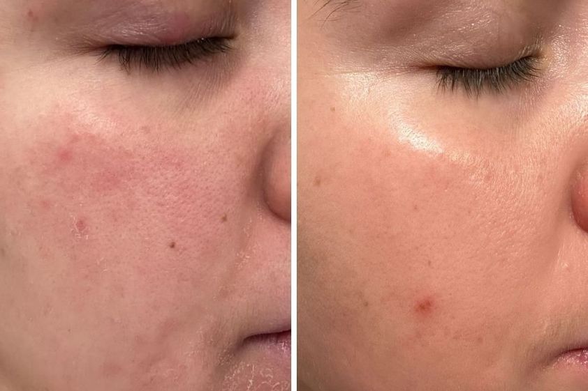 Mesoterapia antes y después - 869784