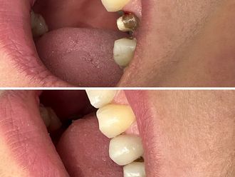 Prótesis dentales antes y después - 869794