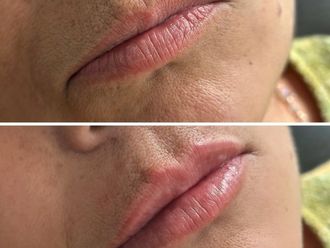 Aumento de labios antes y después - 869800