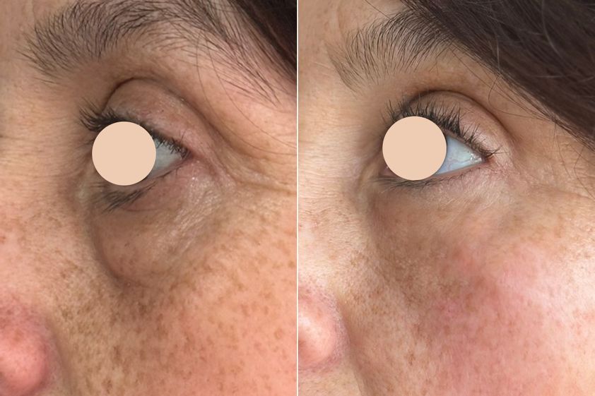 Tratamiento de bolsas en los ojos antes y después - 872226