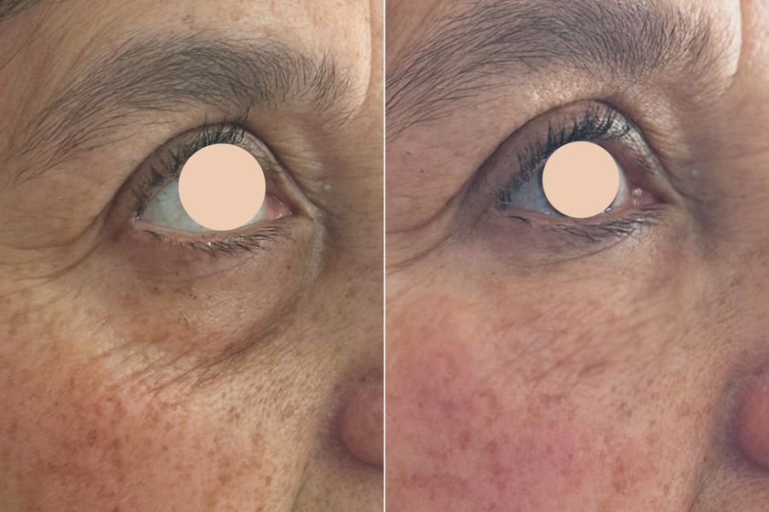 Tratamiento de bolsas en los ojos antes y después - 872227