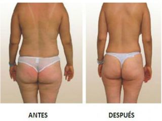 Lipoólisis