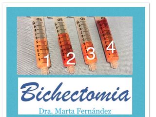 Bichectomia 
