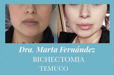 Bichectomía - Dra. Marta Fernández