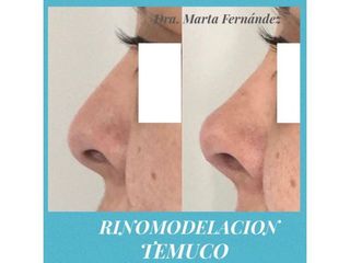 Rinomodelación - Dra. Marta Fernández