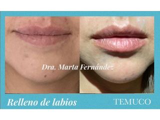 Aumento de labios - Dra. Marta Fernández