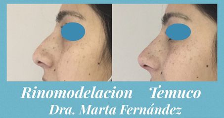 Rinomodelación - Dra. Marta Fernández