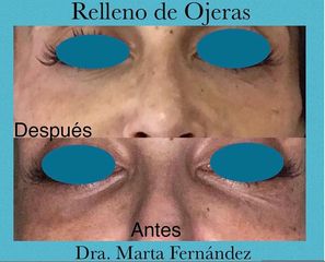 Tratamiento de ojeras - Dra. Marta Fernández