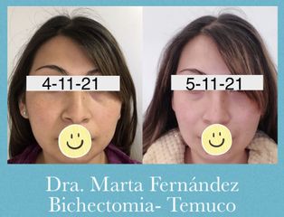 Bichectomia - Dra. Marta Fernández