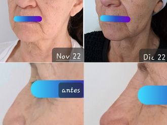 Aumento de pómulo antes y después - 869303