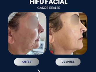 HIFU antes y después - 868347