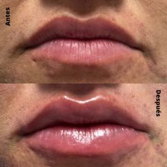 Aumento de labios - IDENTAL