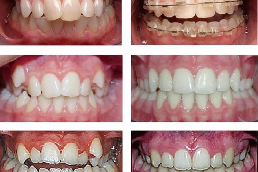 Brackets antes y después - 482570