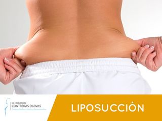 Liposucción