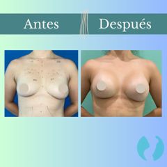 Aumento mamario - Clinica Essenza