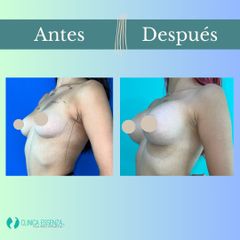 Aumento mamario - Clinica Essenza