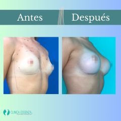 Aumento mamario - Clinica Essenza