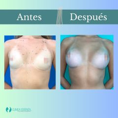 Aumento mamario - Clinica Essenza