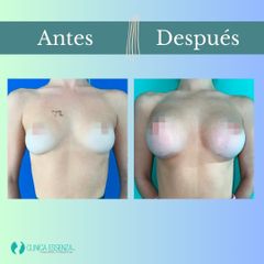 Aumento mamario - Clinica Essenza