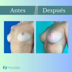 Aumento mamario - Clinica Essenza