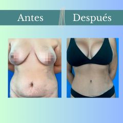 Abdominoplastia - Clinica Essenza