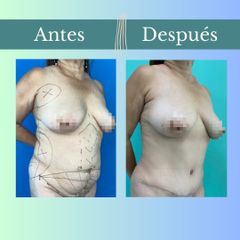 Abdominoplastia - Clinica Essenza