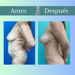 Abdominoplastia - Clinica Essenza