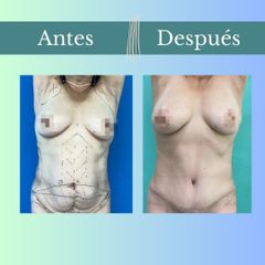 Abdominoplastia - Clinica Essenza