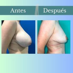 Reducción mamaria - Clinica Essenza