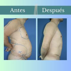 Abdominoplastia - Clinica Essenza