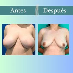 Reducción mamaria - Clinica Essenza