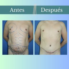 Abdominoplastia - Clinica Essenza