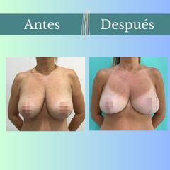 Reducción mamaria - Clinica Essenza