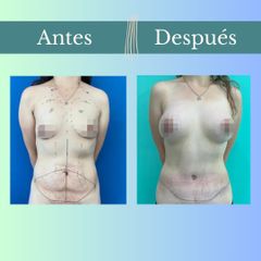 Abdominoplastia - Clinica Essenza