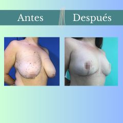 Reducción mamaria - Clinica Essenza
