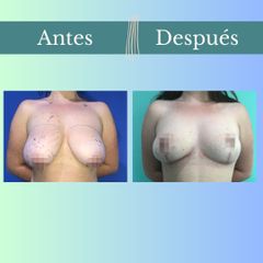 Reducción mamaria - Clinica Essenza