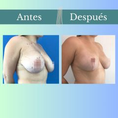 Reducción mamaria - Clinica Essenza