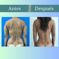 Liposucción - Clinica Essenza